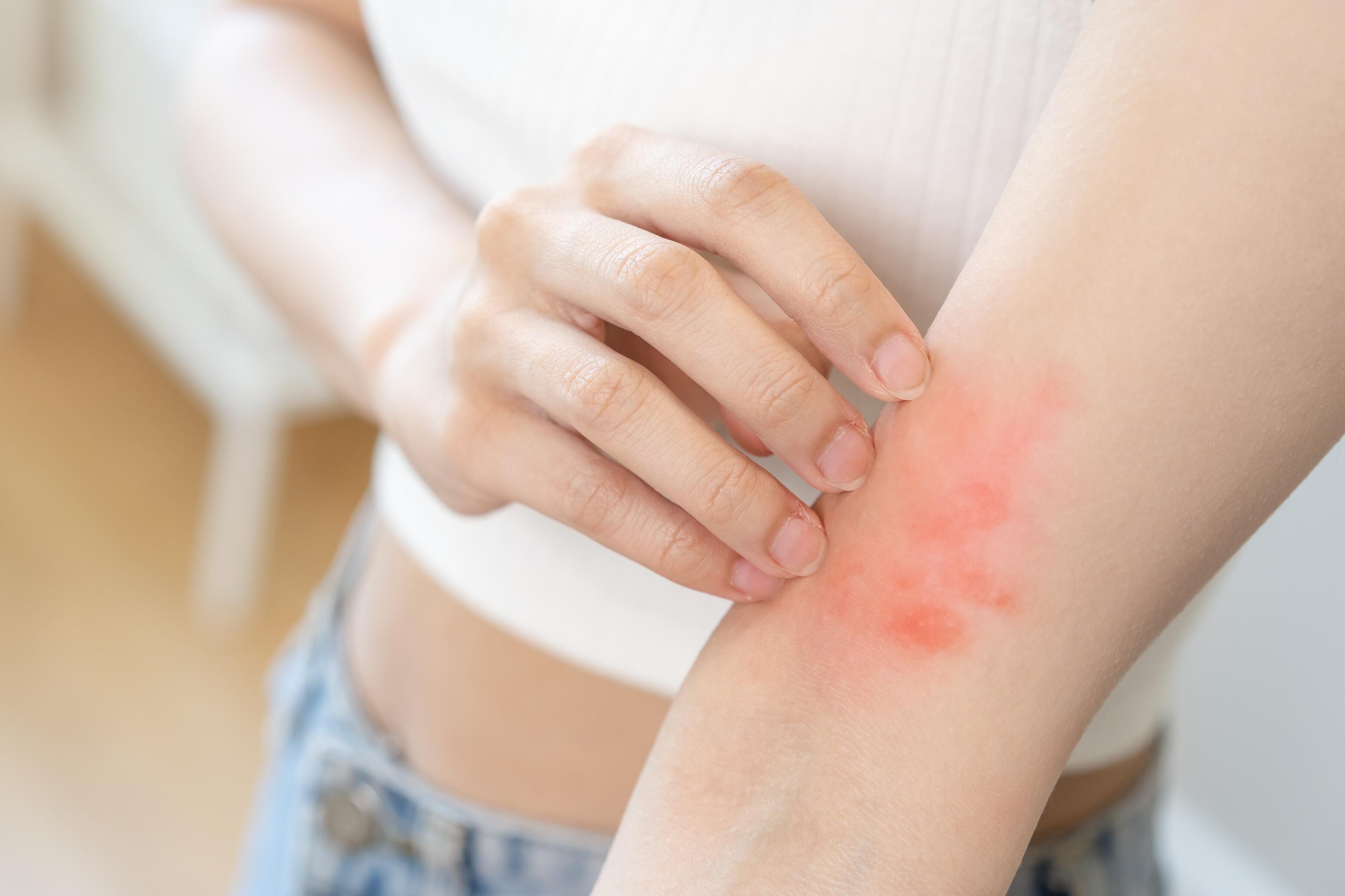 Woman scratching herself in the crease of her elbow because of a red patch of eczema